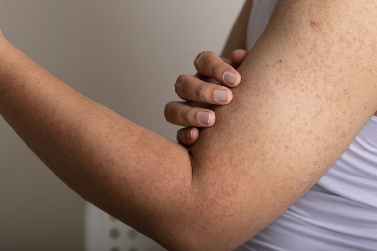 La «Piel de Gallina» La Alteración que Afecta el Autoestima de los Jóvenes