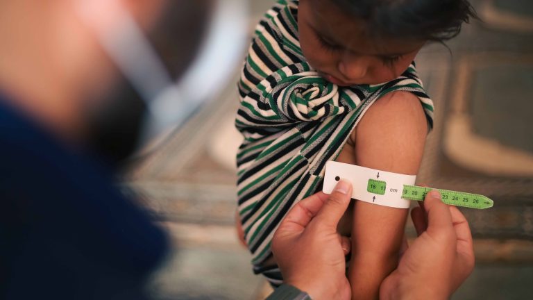 El 20% de las Muertes por Desnutrición en Niños Menores de Cinco Años Ocurren en La Guajira, más del 75% de Estas Muertes Afectan a Niños Indígenas