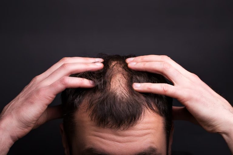 Dermatólogos Lanzan Campaña Para Conocer qué es la Alopecia Areata